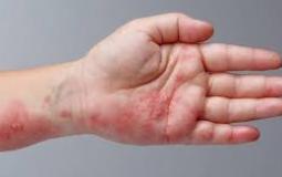 علامات تظهر على الجلد تشير إلى إصابتك بأمراض خطيرة/ توضيحية