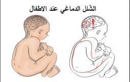 الشلل الدماغي عند الاطفال