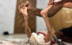 المجاعة في غزة - تعبيرية