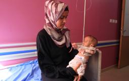 أطفال يعانون من سوء التغذية في غزة