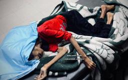 ارتفاع عدد المتوفين نتيجة التجويع في غزة إلى 20 خلال يومين