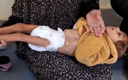 سوء التغذية في غزة