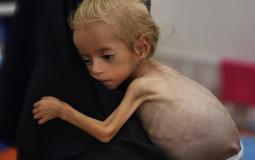 غزة - 3 وفيات بسبب المجاعة وسوء التغذية