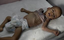 ارتفاع عدد ضحايا المجاعة وسوء التغذية في قطاع غزة