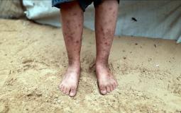 غزة - 17 ألف حالة إصابة مرتبطة بالقوارض