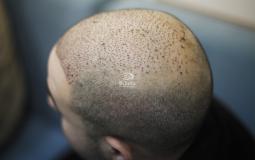 زراعة الشعر في غزة