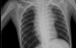 صورة مقطعية لصدر الطفلة التي تعاني من الورم