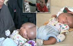 في حادثة نادرة، ولد طفل ذو وجهين، ودماغين في رأس واحد في إندونيسيا.