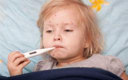 مرض الحصبة عند الاطفال.jpg