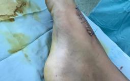  إنهاء معاناة طفل من إعاقة مستديمة فى قدمه