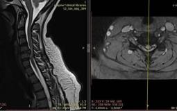 إنقاذ سيدة من شلل رباعي في غزة