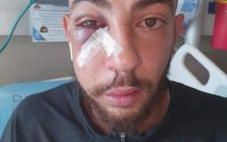 إصابة شاب بكسور في الوجه إثر اعتداء الاحتلال عليه في القدس