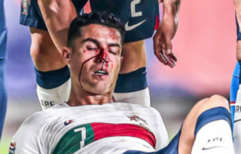 رونالدو يتعرض لإصابة قوية في وجهه