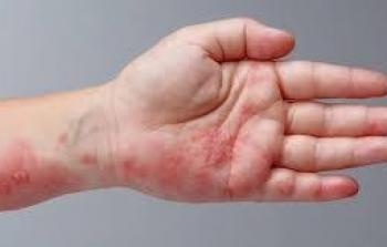 علامات تظهر على الجلد تشير إلى إصابتك بأمراض خطيرة/ توضيحية