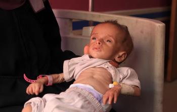 طفل يعاني من سوء التغذية والمجاعة في غزة