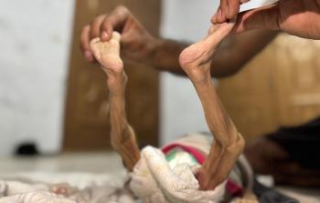 سوء التغذية في غزة - تعبيرية