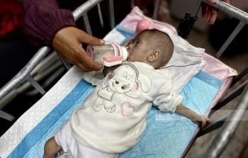 أطفال سوء التغذية في غزة - توضيحية