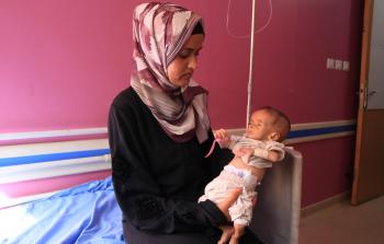 أطفال يعانون من سوء التغذية في غزة