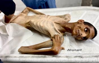 3 وفيات في غزة بسبب سوء التغذية