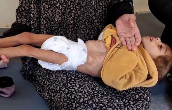 سوء التغذية في غزة - تعبيرية