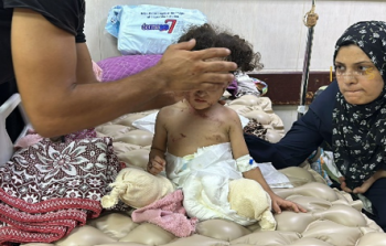 بتر الأطراف في غزة: مأساة إنسانية تتفاقم جرّاء الحرب