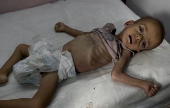 ارتفاع عدد ضحايا المجاعة وسوء التغذية في قطاع غزة