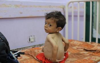 أطفال غزة يعانوا من سوء التغذية