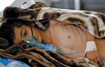 مصاب بمرض الكوليرا في اليمن