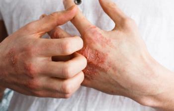 مرض اكزيما الجلد