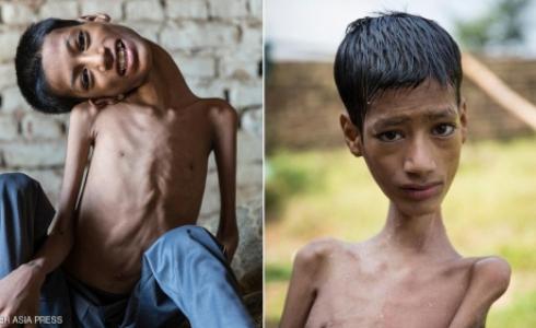 الطفل كان عاجزا عن ممارسة حياته الطبيعية