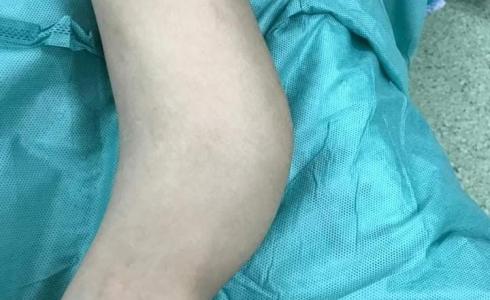 طاقم طبي مجمع ناصر يجري أول عملية جراحية بتقنية "ماسكيليه" لطفل