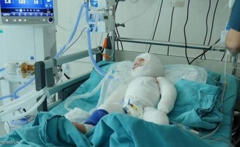 الطفلة السورية دلال المصابة بالحروق