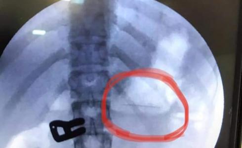 استخراج دبوس بطول 2سم بالمنظار من معدة فتاة