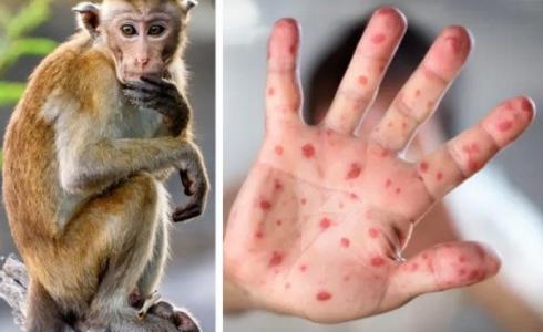 مرض جدري القرود