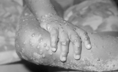 مرض جدري القرود