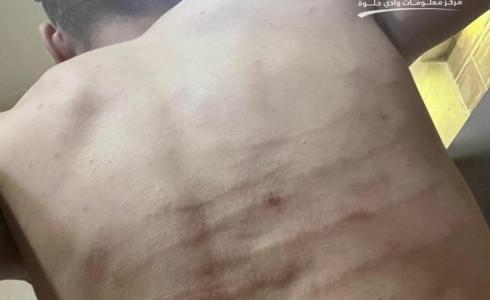 مستوطنون يعتدون على شاب مقدسي بعد دهسه