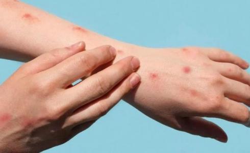 جدري القرود