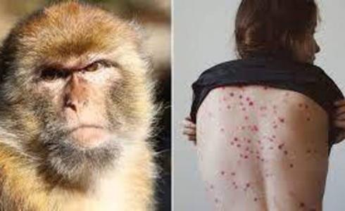 تسجيل أول حالة وفاة بجدري القرود في أمريكا 