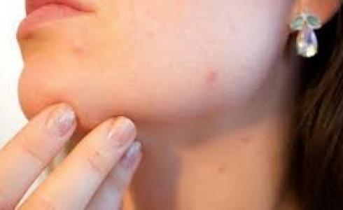 جدري القرود - ارشيف