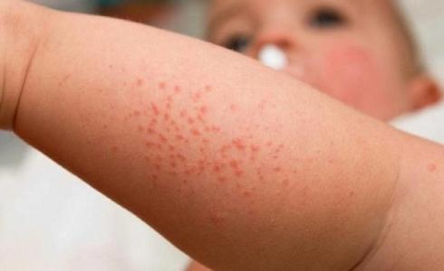 الحمى القرمزية