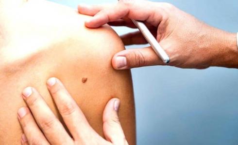 جهاز فوري للكشف عن سرطان الجلد