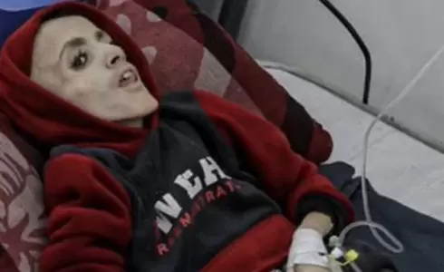 تحول الى هيكل عظمي - استشهاد الطفل يزن الكفارنة في غزة