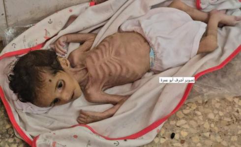 وفاة الطفلة جوري المصري 3 شهور في دير البلح وسط قطاع غزة بسبب سوء التغذية