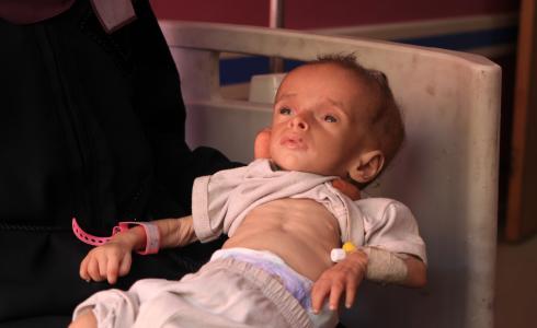 طفل يعاني من سوء التغذية والمجاعة في غزة