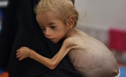 طفلة تعاني من سوء التغذية في غزة