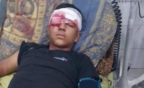 إصابة طفل بجروح خطيرة خلال اقتحام الاحتلال بيت عوا
