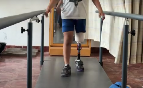 مبتورو الأطراف في غزة