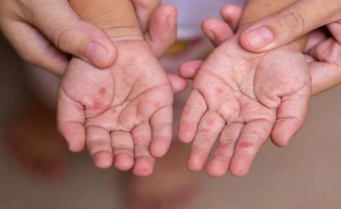 الزراعة تحذر من سلالة "غير مسبوقة" للحمى القلاعية