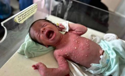 الأمراض الجلدية في غزة تنهش أجساد النازحين تحت حرّ الخيام