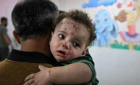 تحذيرات من اتساع رقعة "جدري الماء" في قطاع غزة
